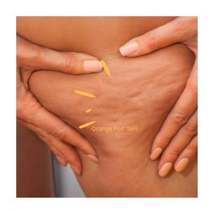 Orange Peel Skin